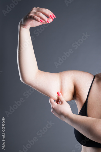 Fat and cellulite removal concept, overweight female hand