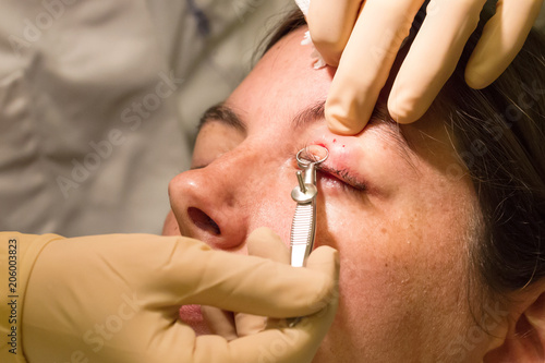 Healthcare concept - Chalazion during eye examination and operation photo