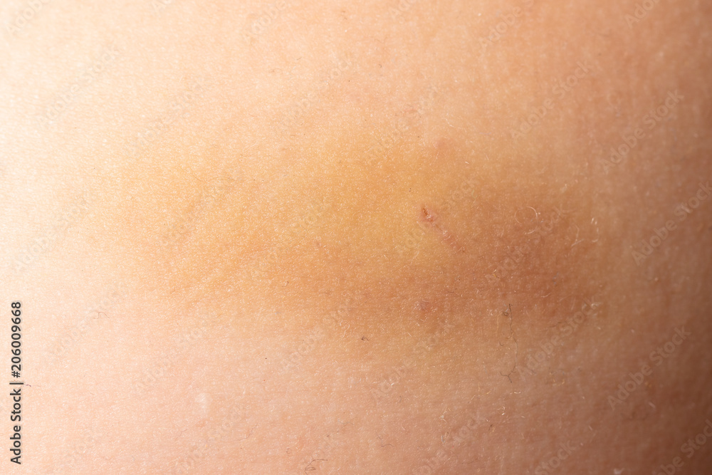 A bruise on the skin of a man A bruise on the skin of a man