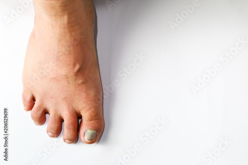 Foto Close up of ingrown toenail is Inflamed fingernails