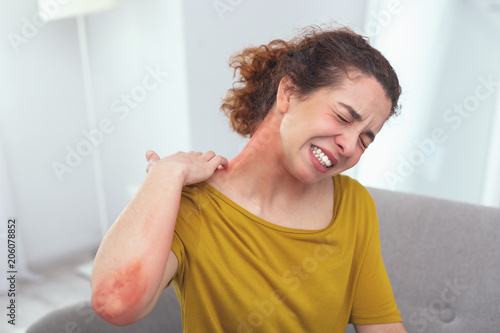 Spreading rash. Young lady in pain looking awfully sick suffering from a spreading skin rash affecting her neck photo