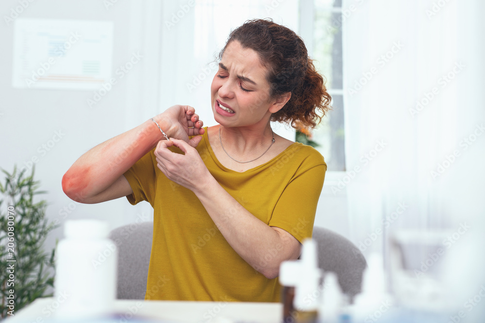 Awful itchiness. Young woman looking desperate and sore while applying some daily medical procedures curing her allergic rash on inflamed arm