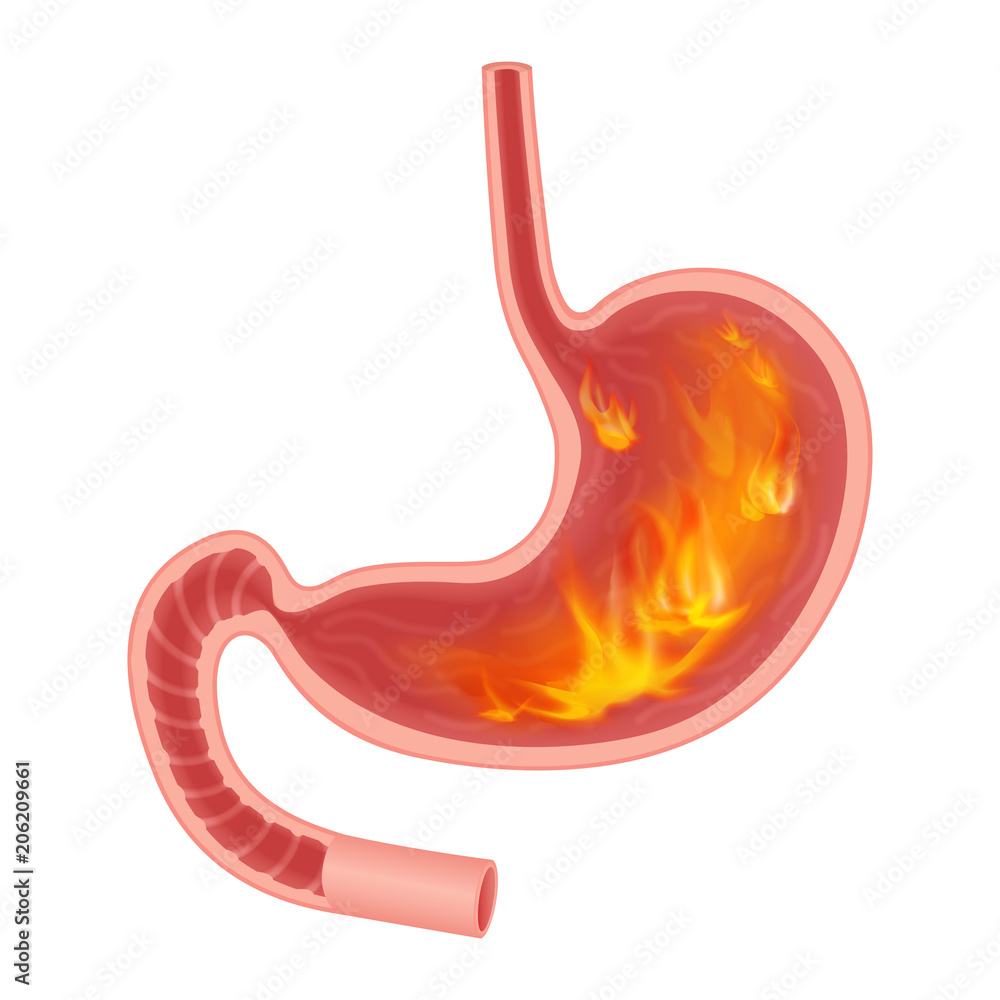 Realistic medical illustration of pyrosis stomach isolated. Fire disorder inside stomach. Realistic medical illustration of pyrosis stomach isolated. Fire disorder inside stomach.