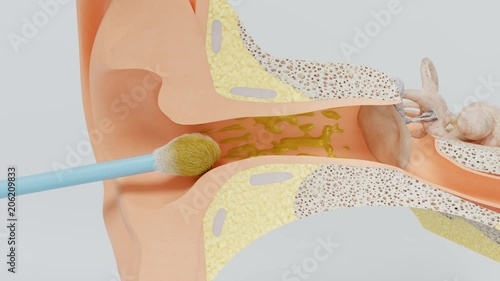 Right way of using cotton swab. Ear wax cleaning.