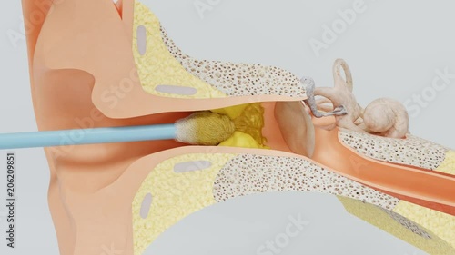 Wrong way of using cotton swab. Formation of ear wax blockage.