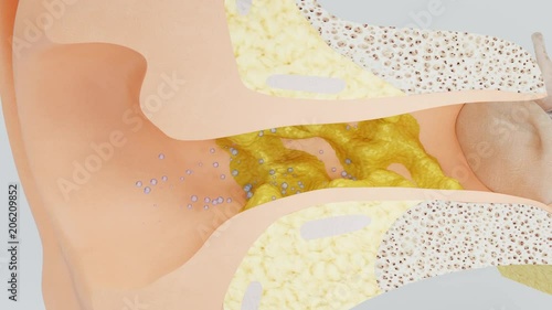 Ear wax swells at high humidity. 