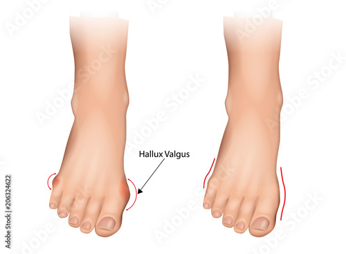 Illustration of the normal foot and hallux valgus. Human foot deformity. Hallux valgus and tailors bunion.