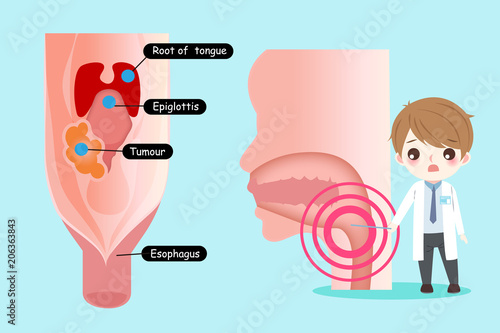 doctor with oral cancer concept