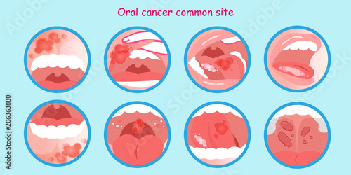 oral cancer commom site photo