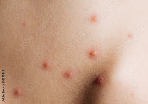 Tablou pe pânză Detail baby with chicken pox rash