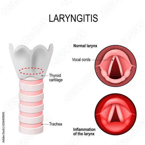 Laryngitis. normal and Inflamed larynx photo
