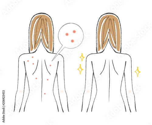 背中のビフォーアフター  ニキビ