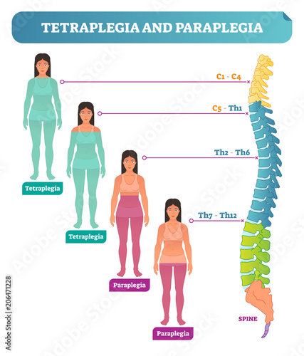 Tetraplegia and paraplegia spinal neural disorder medical vector illustration diagram with female patient and back bone cross section scheme.