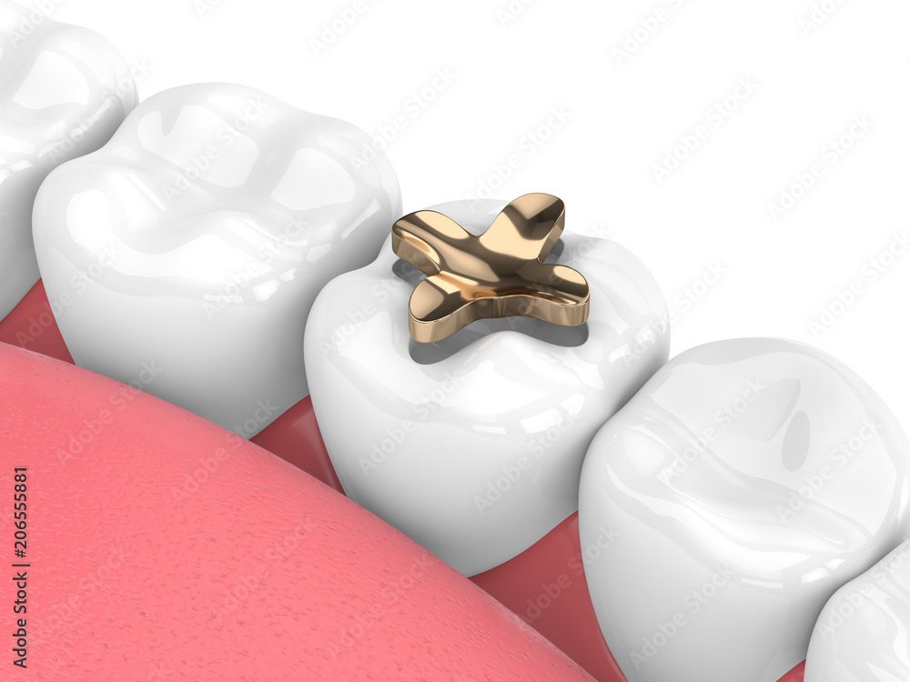 3d render of teeth with dental inlay golden filling 3d render of teeth with dental inlay golden filling