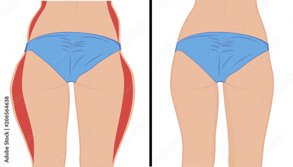 Fat thigs correction. Liposuction. Before and after. Woman body correction vector illustration Fat thigs correction. Liposuction. Before and after. Woman body correction vector illustration