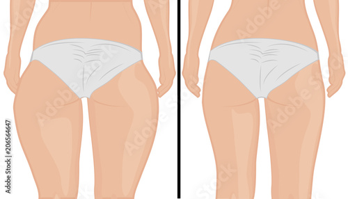 Fat thigs correction.  Liposuction. Before and after. Woman body correction vector illustration photo