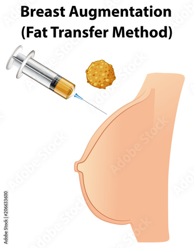 A Human Anatomy Breast Augmentation