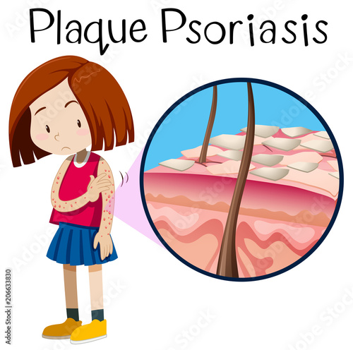 A Vector of Girl Plaque Psoriasis