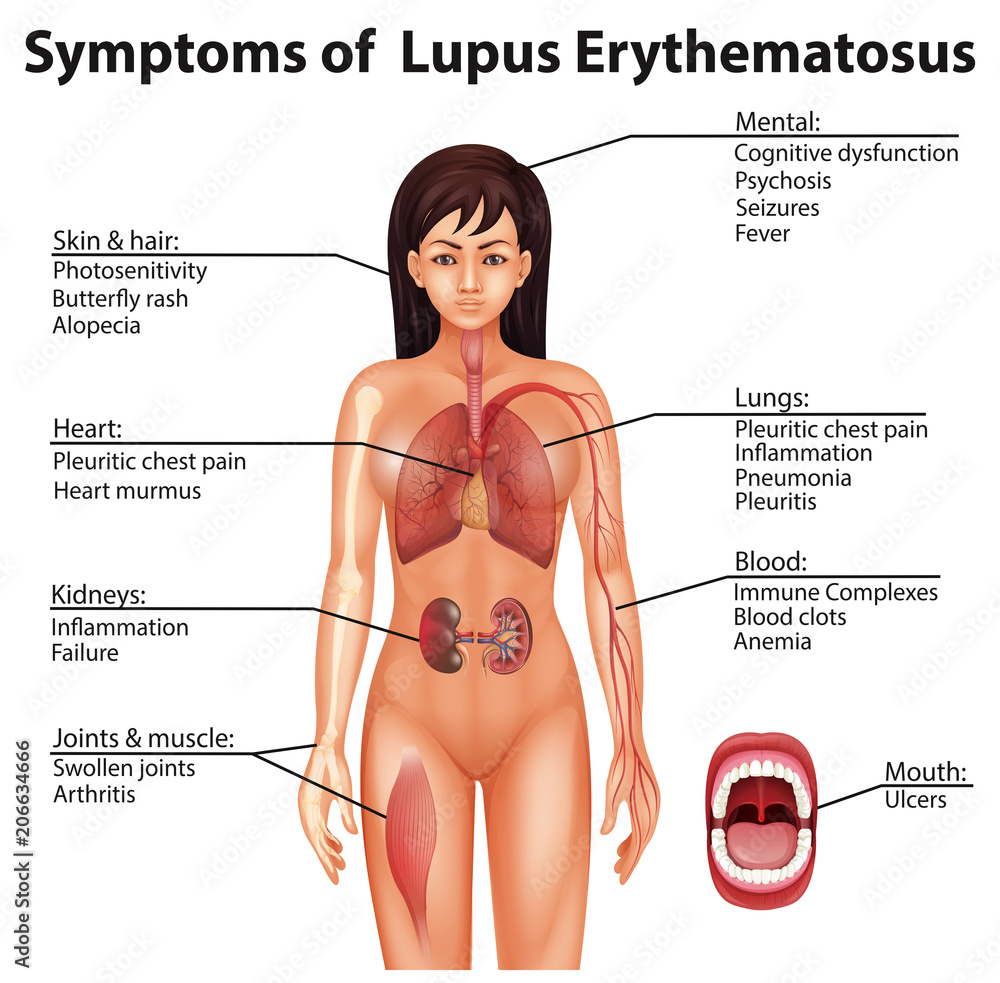 Human Anatomy Symptoms of Lupus Erythematosus Stock-vektor | Adobe Stock