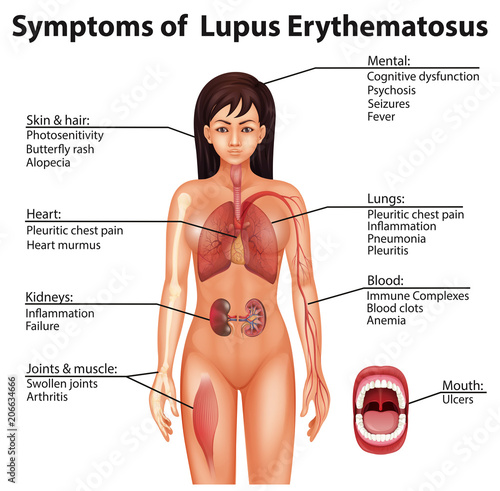Human Anatomy Symptoms of Lupus Erythematosus