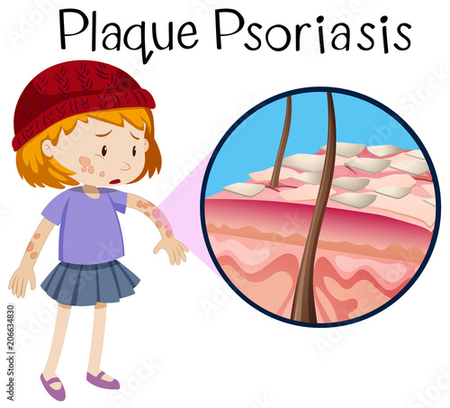 Human Anatomy of Plaque Psoriasis