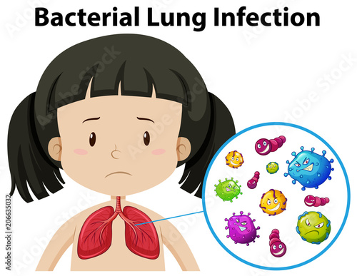 A Vector of Bacterial Lung Infection