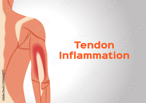arm tendon inflammation vector photo