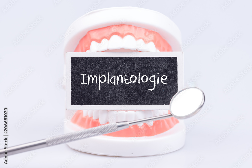 Implantologie beim Zahnarzt - obrazy, fototapety, plakaty 