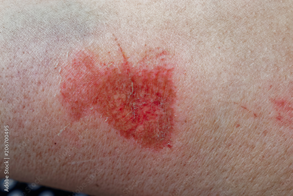 Scratched skin on arm Scratched skin on arm
