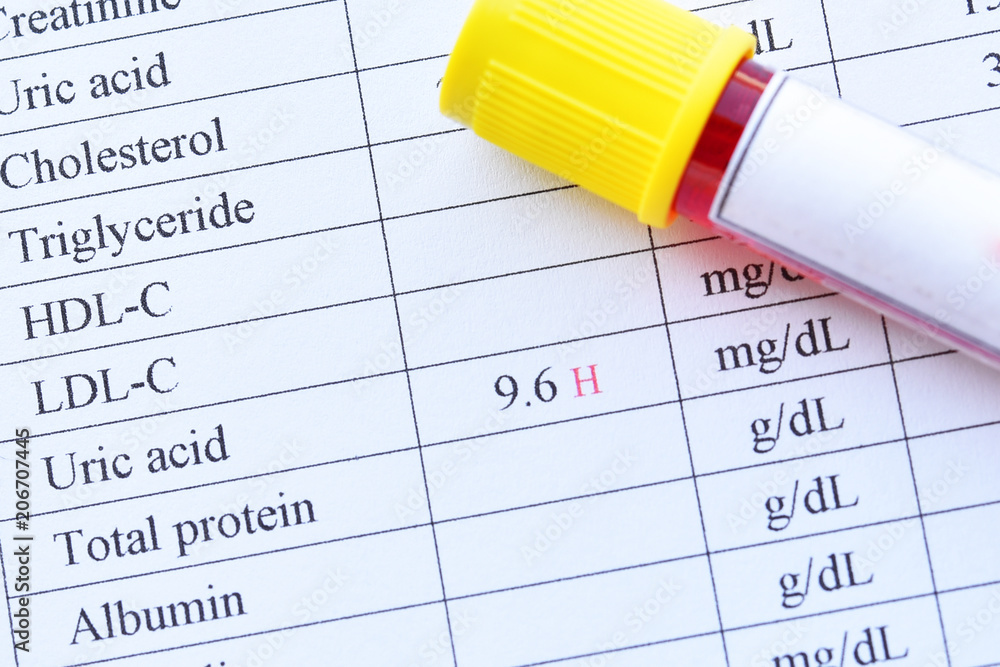 Blood sample tube with abnormal high uric acid test result Stock Photo