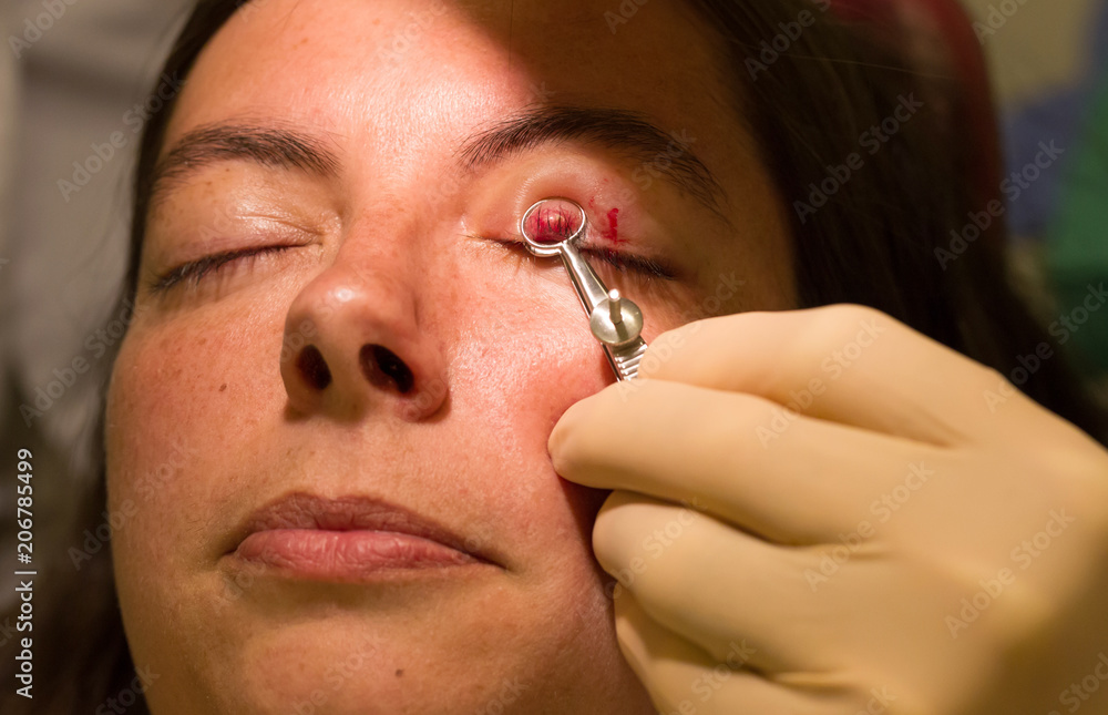 Healthcare concept - Chalazion during eye examination and operation - obrazy, fototapety, plakaty 