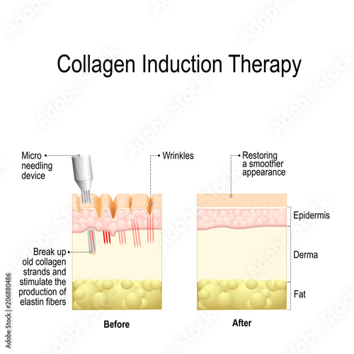 Collagen induction therapy (microneedling) photo