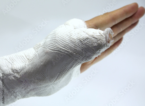 Hand of the injured person with the broken limb