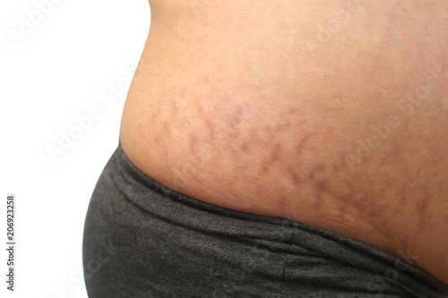 Billede på lærred stretch marks on skin pregnant woman with close up shot.