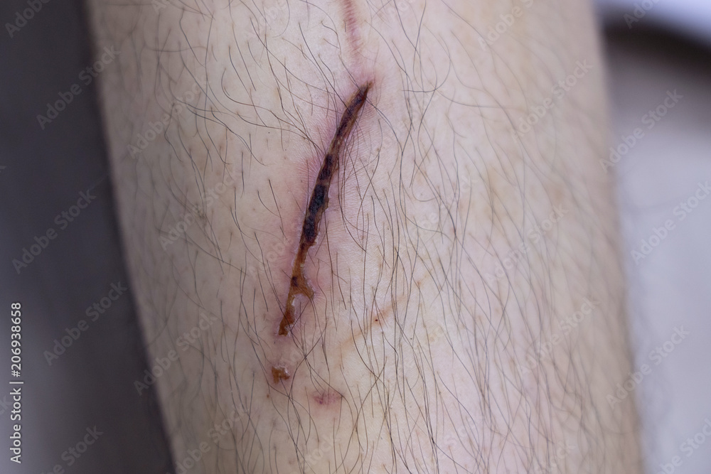 dried crust from wound on human leg Stock Photo Adobe Stock