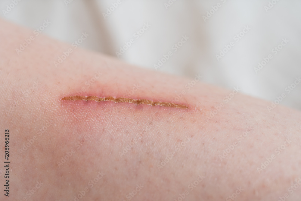 Very close up of painful wound Very close up of painful wound