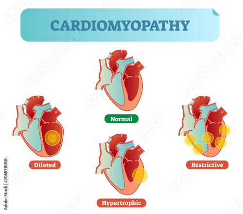 Cardiomyopathy medical disorders cross section diagram, vector illustration examples with normal, dilated, hypertrophic and restrictive conditions.