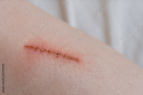 Child injured. Close up wound on child leg.