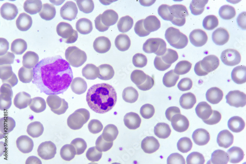 Monocyte and neutrophil cell in blood smear, analyze by microscope photo