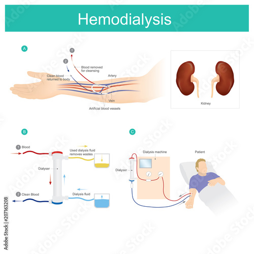 Hemodialysis. Patient blood is put through a filter outside your body, cleaned, and then returned to you. photo