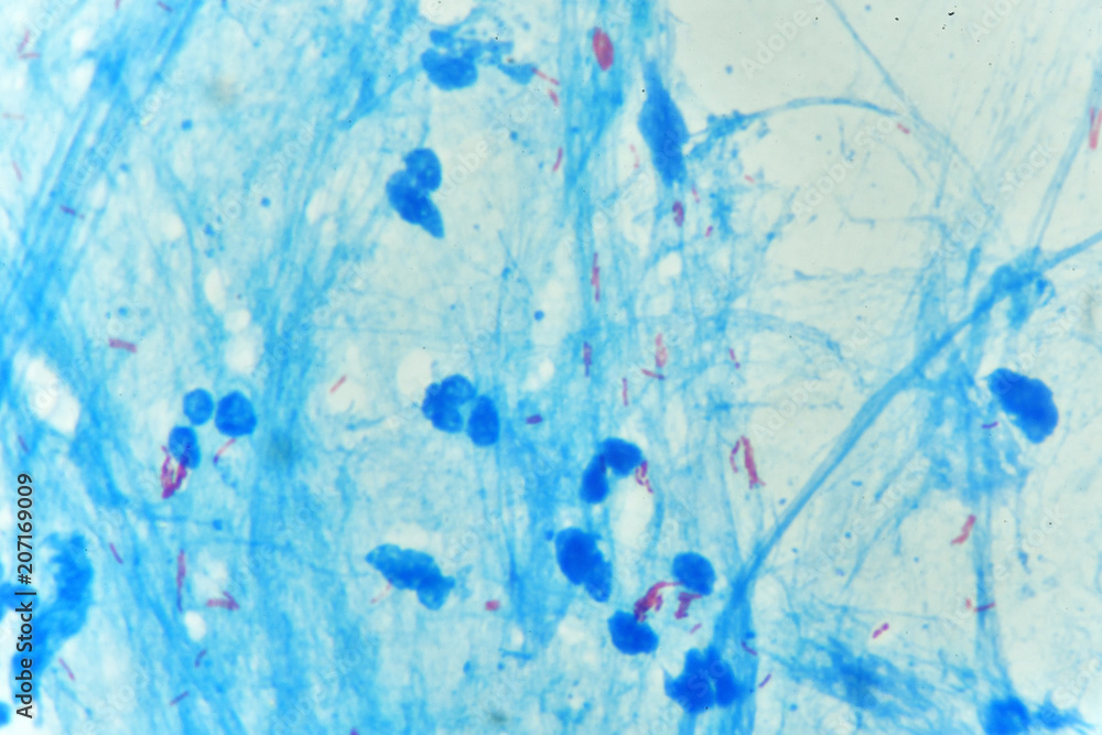 Mycobacterium positive (small red rod) in acid fast stain sputum, specimen from tuberculosis