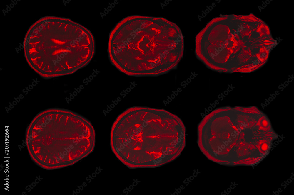 X-ray image of the brain computed tomography X-ray image of the brain computed tomography