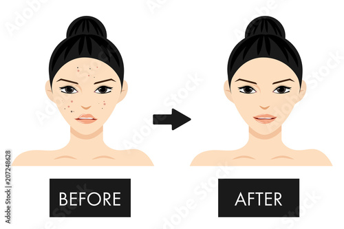 Woman before and after acne, pore and black spot vector