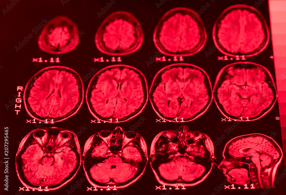 .he result of MRI of the brain of a healthy person with red light. The longitudinal section of the brain. . .he result of MRI of the brain of a healthy person with red light. The longitudinal section of the brain. .