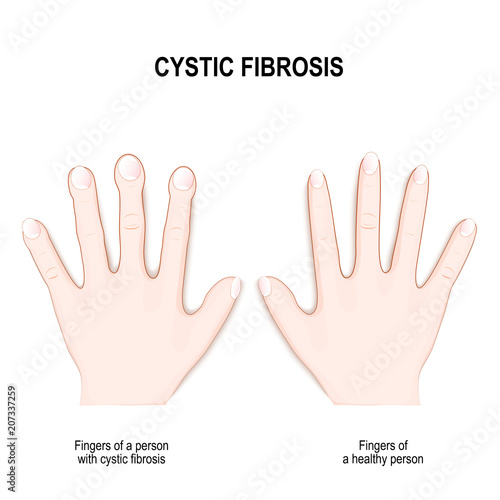 Cystic fibrosis. Nail clubbing Symptoms