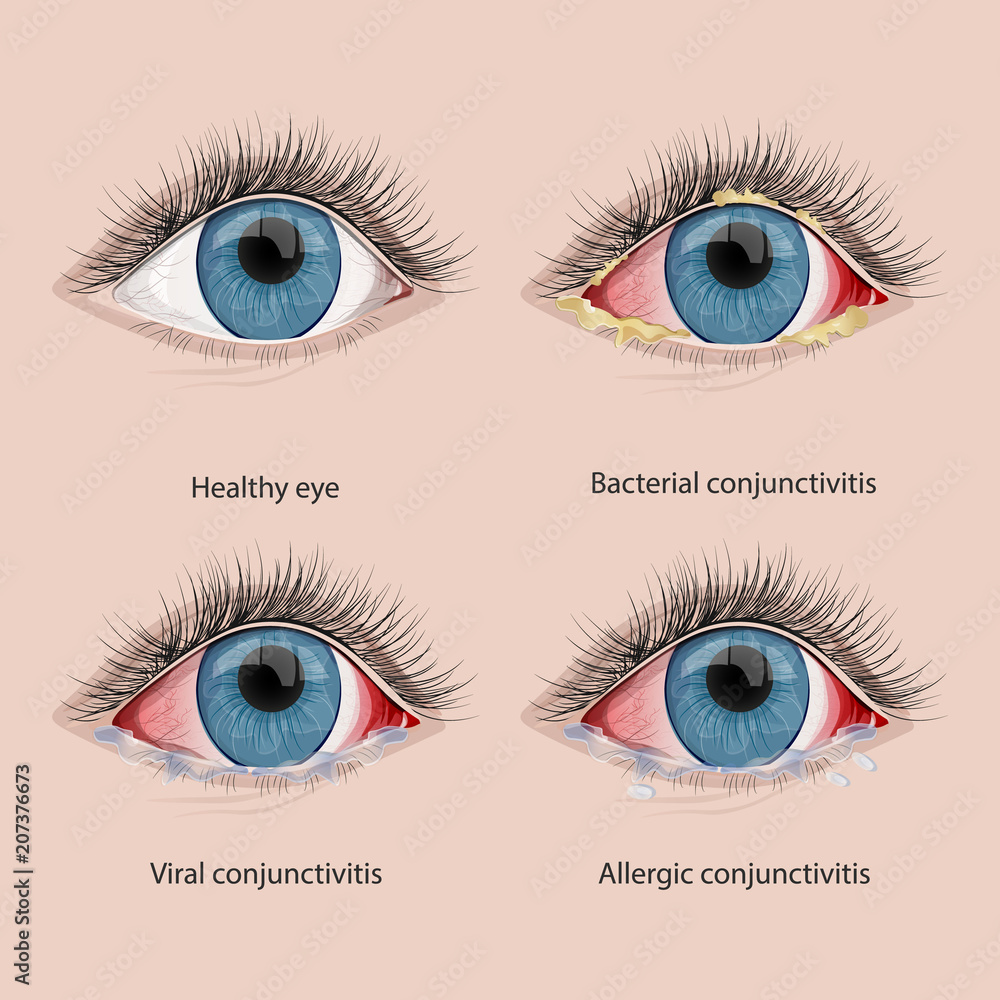 types of conjunctivitis