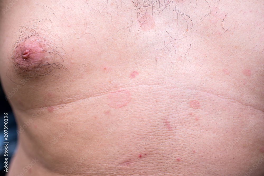 Ringworm on the body Ringworm on the body