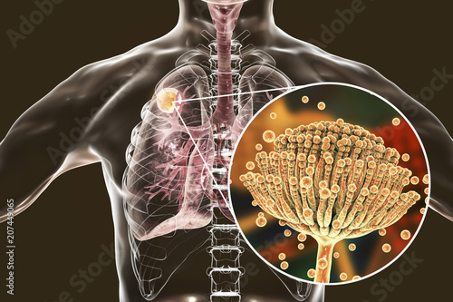 Aspergilloma of the lung and close-up view Aspergillus fungi, 3D illustration. Also known as mycetoma, or fungus ball, a lesion produced by fungi Aspergillus in immunocompromised patients