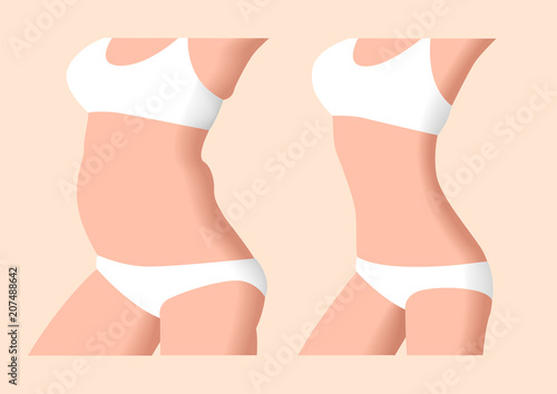 liposuction before and after , fat , diet , surgery