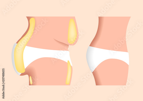 liposuction before and after , fat , diet , surgery